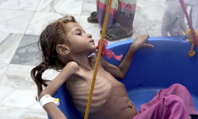 Photo of starving child in Yemen