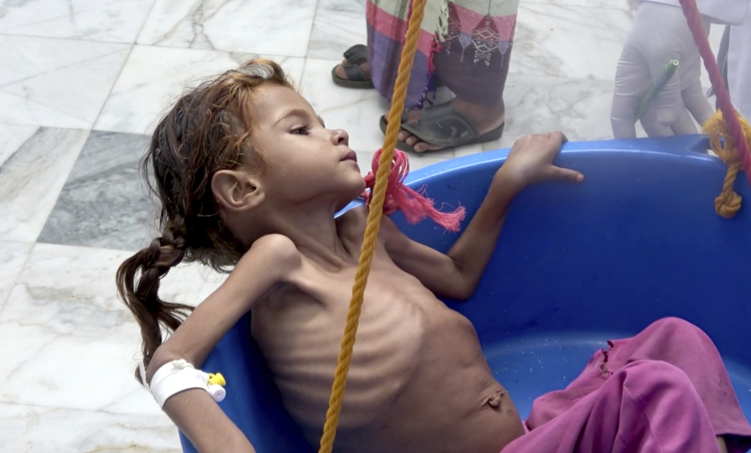 Photo of starving child in Yemen